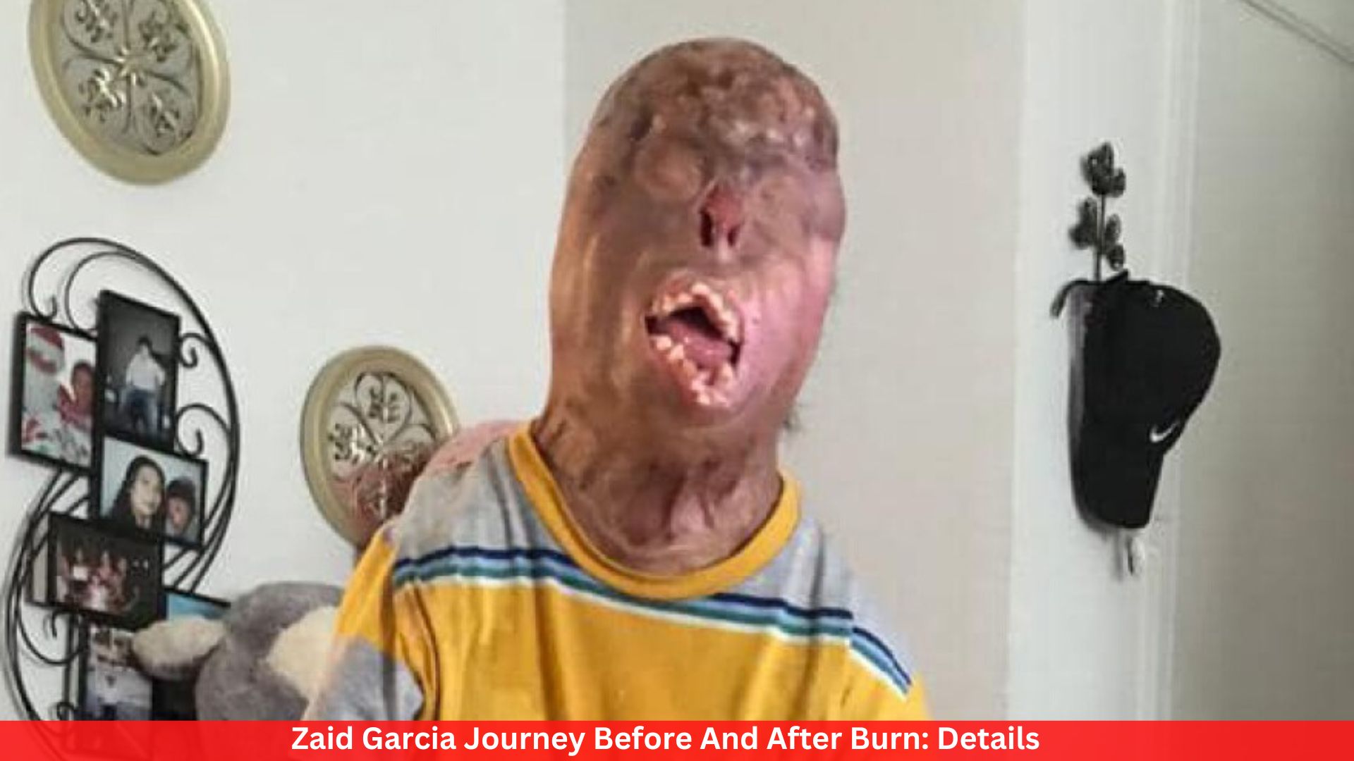 Zaid Garcia Journey Before And After Burn: Details